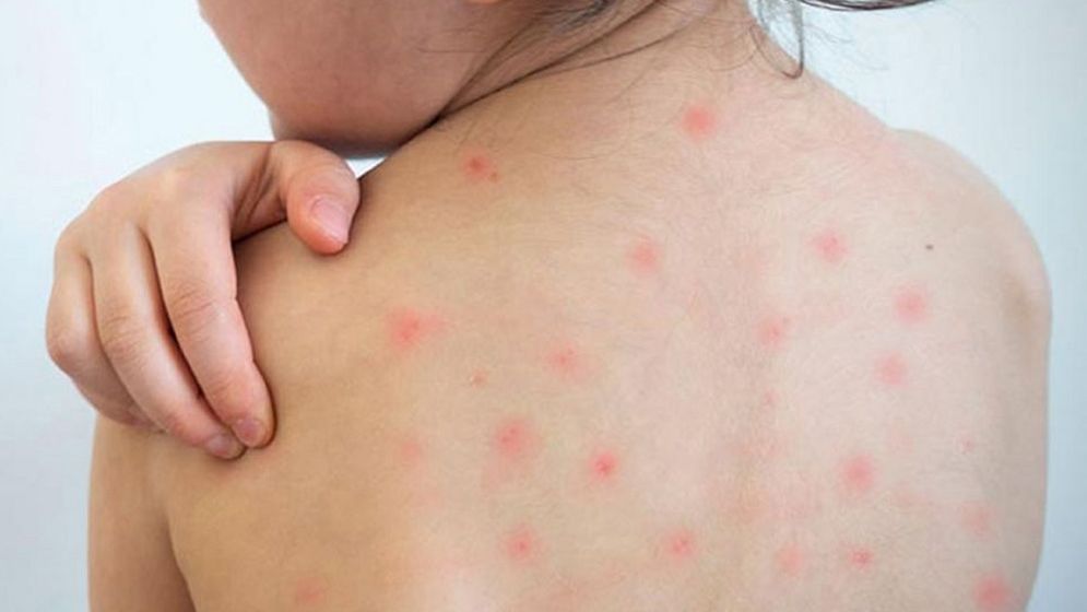 হামের প্রকোপে বাড়ছে মৃত্যু ও উদ্বেগ, টিকাদান কর্মসূচি জোরদার