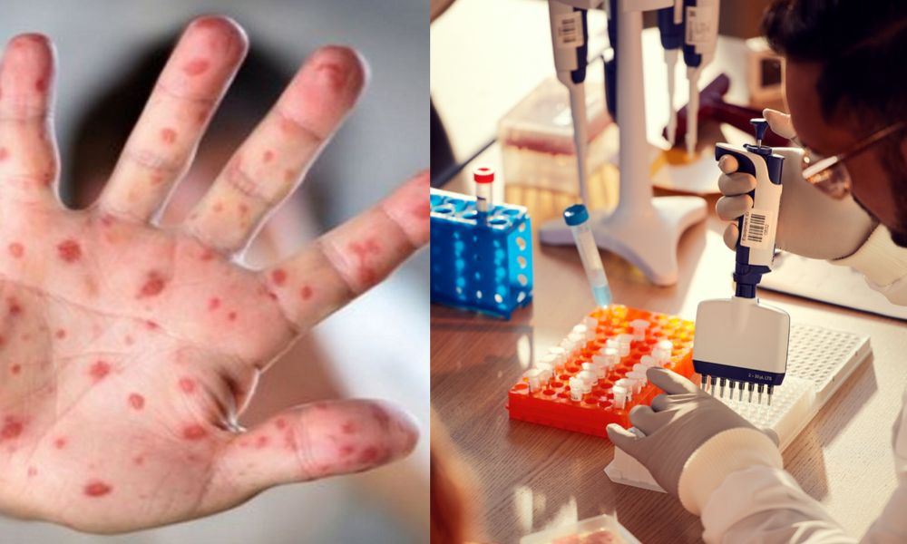 বাংলাদেশে ফের বাড়ছে হাম, টিকাদানের ঘাটতিকে দায় দিলেন বিশেষজ্ঞ