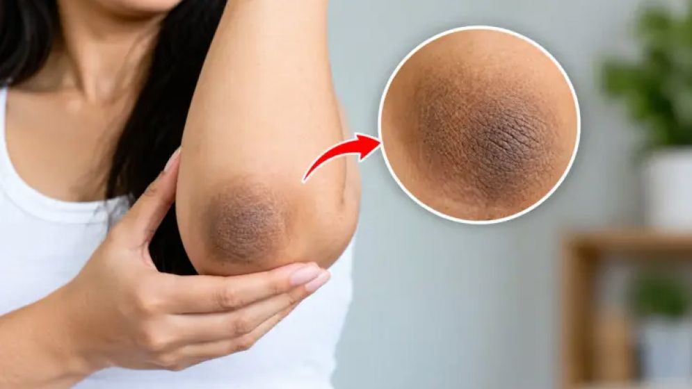 কনুইয়ের কালচে দাগ দূর করতে যা করবেন